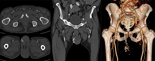 Phleboliths (seen as punctiform calcifications) in the scrotum of an individual with varicocoele. Phlebolithen in skrotaler Varicocele 69M - CT - 001.jpg