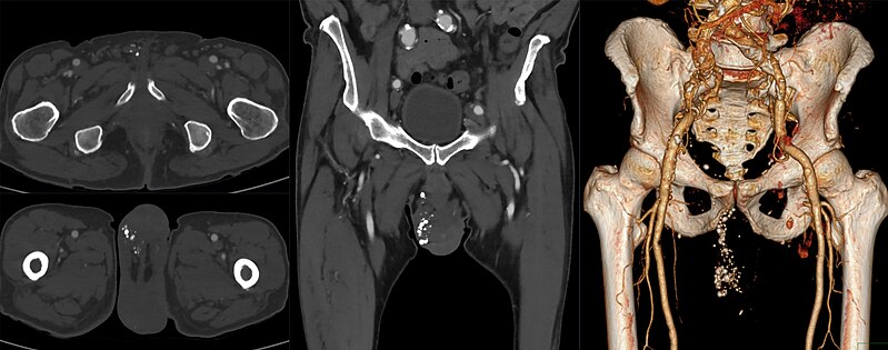 File:Phlebolithen in skrotaler Varicocele 69M - CT - 001.jpg