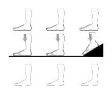 .mw-parser-output .plainlist ol,.mw-parser-output .plainlist ul{line-height:inherit;list-style:none;margin:0;padding:0}.mw-parser-output .plainlist ol li,.mw-parser-output .plainlist ul li{margin-bottom:0}
Right column: the shoe is loose, and when walking, particularly downhill, the foot slides back and forth within the shoe.
Center: there is too little ease for arches to extend when walking, and the shoe is too tight.
Left: a properly-fitting shoe. Preventing black toenail subungual hematoma.svg