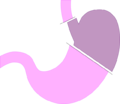 simple diagram of proximal gastrectomy