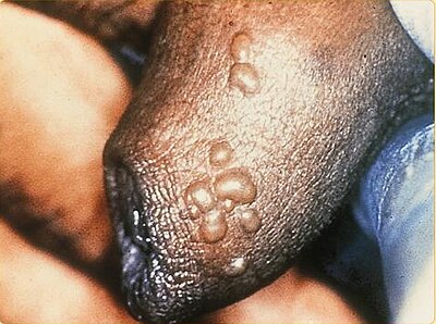 Herpes genitale.