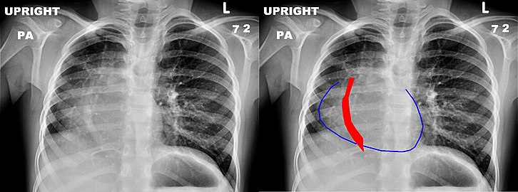 Chest x-ray of a five-year-old girl with Scimitar syndrome. The heart (blue outline) is shifted into the right half of the chest, and the anomalous pulmonary venous return (red) has a shape reminiscent of a Scimitar.