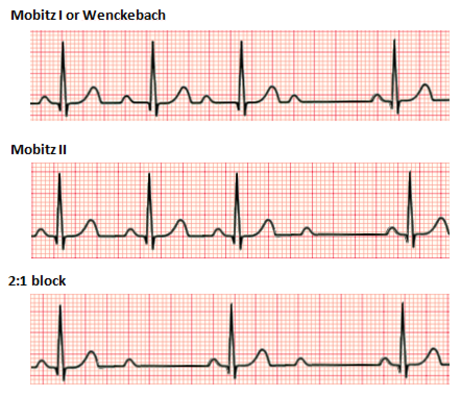 Second-degree atrioventricular block