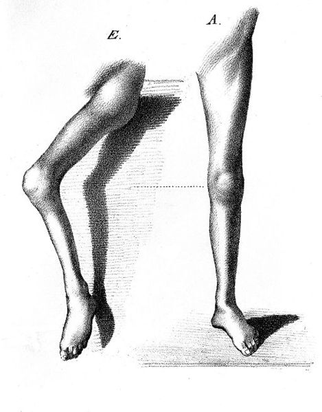 File:Treatment of hemiplegia Wellcome M0011329.jpg