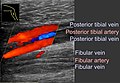 Planul coronar (observat din partea medială a piciorului inferior) ultrasonografie a trombozei venoase profunde a venelor fibulare, văzută ca un conținut hiperecogen și doar flux sanguin marginal.