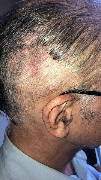 File:Ventriculoperitoneal shunt - surgical wound healing - head - day 15 - stitches removed - 2018.jpg