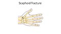 Wrist fracture - Scaphoid fracture