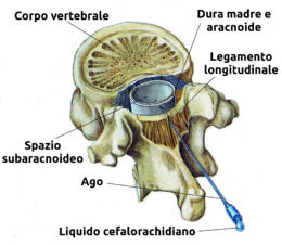 Anestesia spinale.png