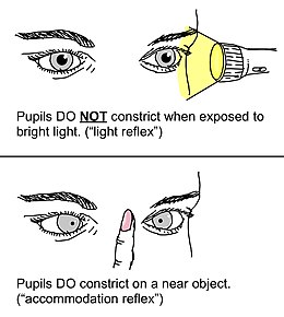 Obrázek Popis Argyll Robertson žák světelný reflex vs ubytování reflex.jpg.