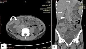 Fig. 19. NHL in a 17 year old HIV positive patient. A. Irregular homogenously enhancing wall thickening involving the ileocaecal region with aneurysmal dilatation of involved segments (curved arrow). B. Hepatosplenomegaly with hepatic metastasis (white arrows).[1]