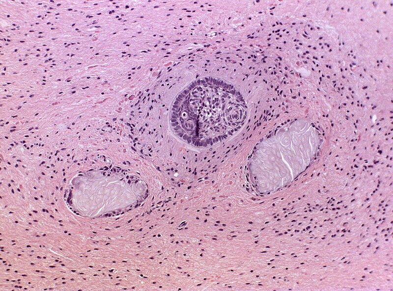 File:Craniopharyngeoma CNS infiltration.jpg