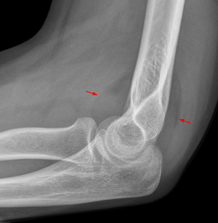 Fat pad sign radiologic sign