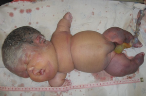 Greenberg Skeletal Dysplasia first reported case in the Democratic Republic of Congo P01.png