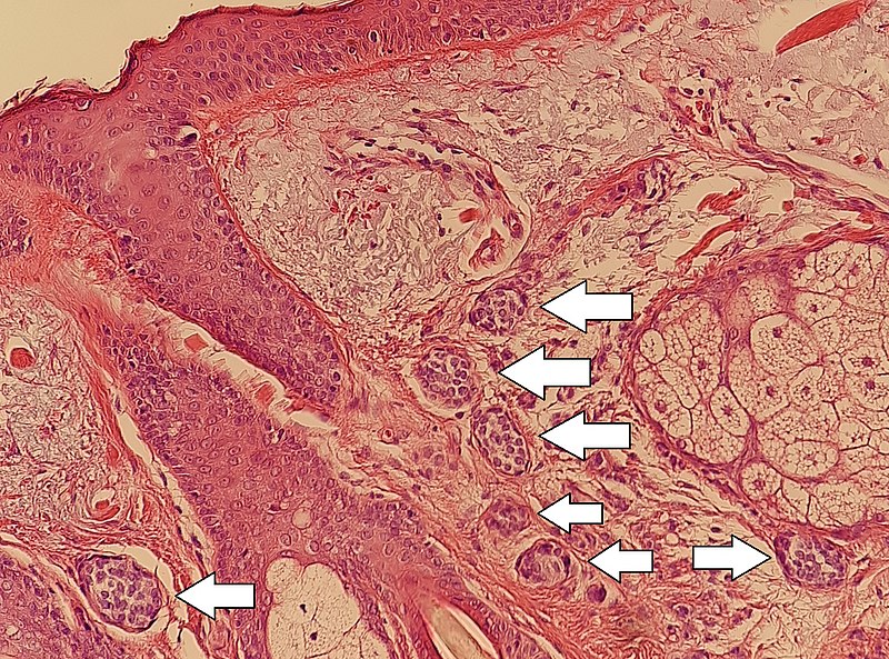 File:Histopathology of a dermal nevus.jpg