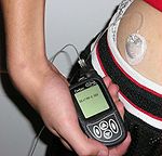 Insulin pump with infusion set.jpg