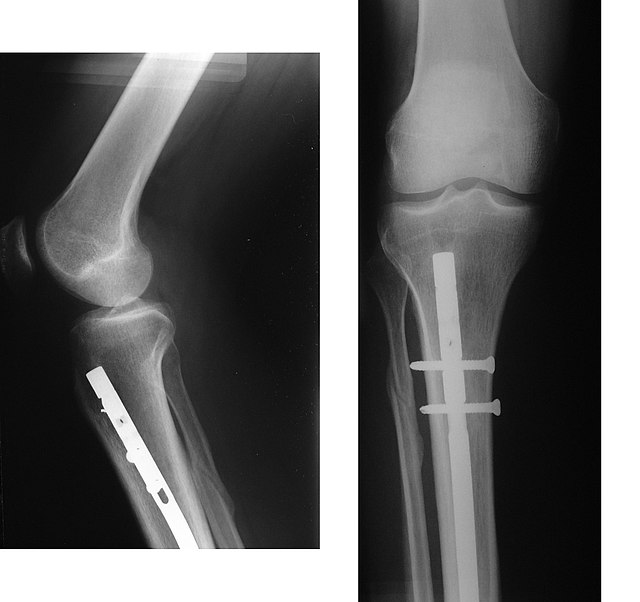 Fracture Tibia with Implant Stock Image - Image of care, knee: 92990275