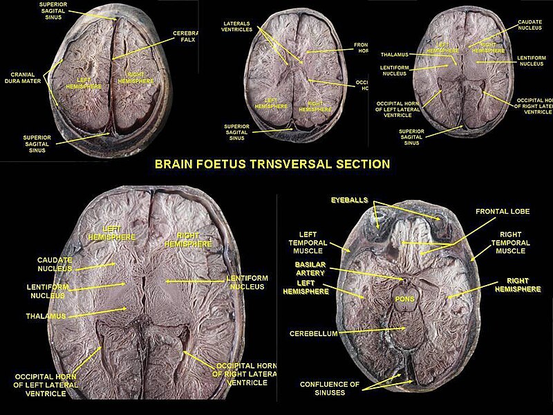 File:Lateral ventricles.jpg