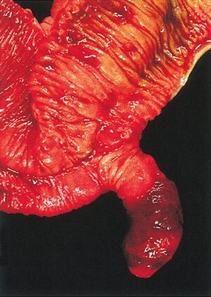 Meckel's Diverticulum AFIP.jpg