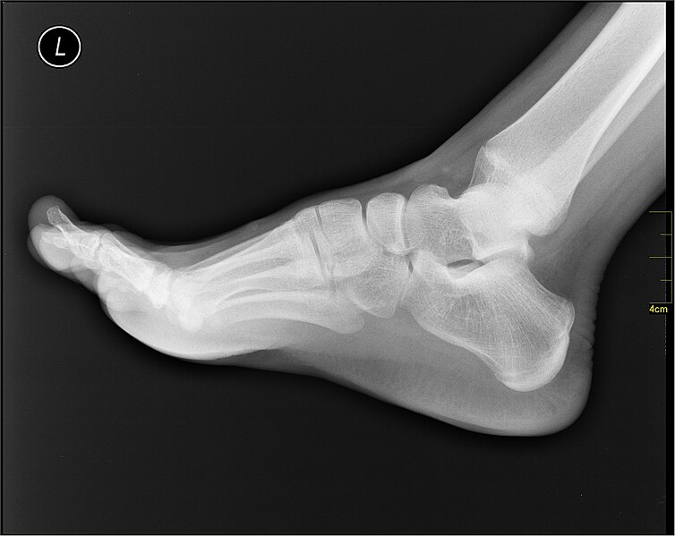 File:Medical X-Ray imaging RAQ06 nevit.jpg