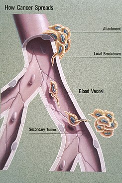 Metastase illustrasjon.jpg