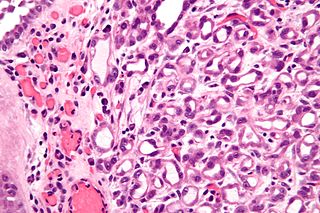 <span class="mw-page-title-main">Nephrogenic adenoma</span> Medical condition