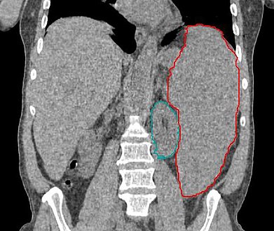 Enlarged spleen due to myelodysplastic syndrome; CT scan coronal section, spleen in red, left kidney in green