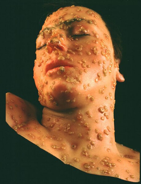 File:Wax model of smallpox lesions on the face of a 15 year old boy.jpg