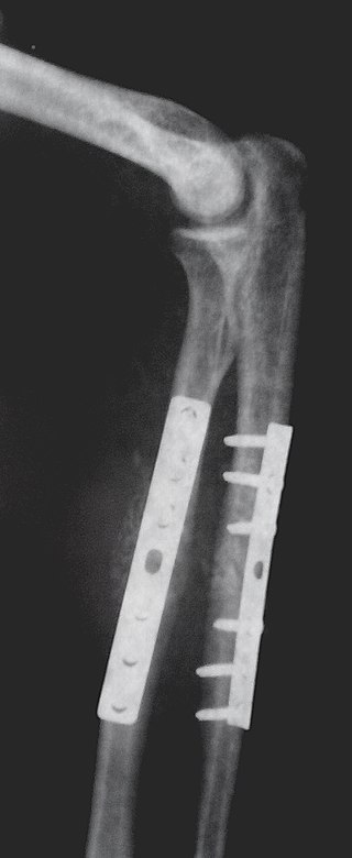 <span class="mw-page-title-main">Internal fixation</span> Orthopedic operation to fix bone