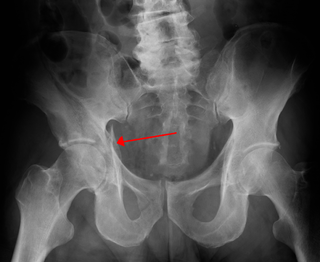 <span class="mw-page-title-main">Acetabular fracture</span> Broken bone in acetabular portion of hip bone