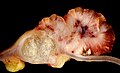 Adenocarcinoma mucinoso (sinistra). L'immagine mostra anche un adenoma villoso (a destra) alla base del quale si sviluppa il tumore invasivo
