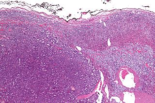 <span class="mw-page-title-main">Adrenocortical carcinoma</span> Medical condition