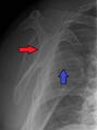 Anterior dislocation of the right shoulder. Y view X ray.