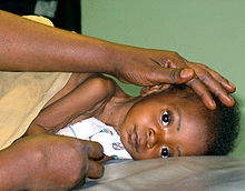 Child being prepared for lumbar puncture.jpg