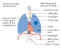 IIIB փուլը թոքի քաղցկեղի