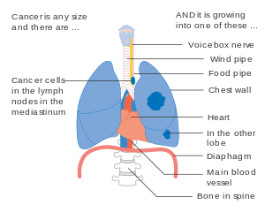 Diagram 2 of 2 showing stage 3B lung cancer CRUK 011.svg
