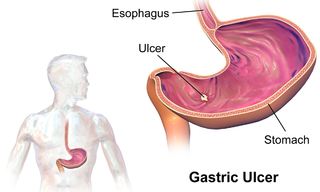 <span class="mw-page-title-main">Ulcer</span> Index of articles associated with the same name