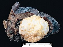 Parenchymal hamartoma of the lung. The surrounding lung falls away from the well-circumscribed mass, a typical feature of these lesions. The hamartoma shows a variegated yellow and white appearance, which corresponds respectively to fat and cartilage. Hamartoma of the lung.jpg