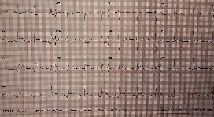 A 12-lead ECG showing an inferior STEMI due to reduced perfusion through the right coronary artery. Elevation of the ST segment can be seen in leads II, III and aVF.