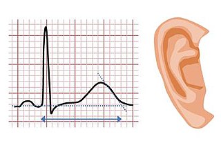 <span class="mw-page-title-main">Jervell and Lange-Nielsen syndrome</span> Medical condition