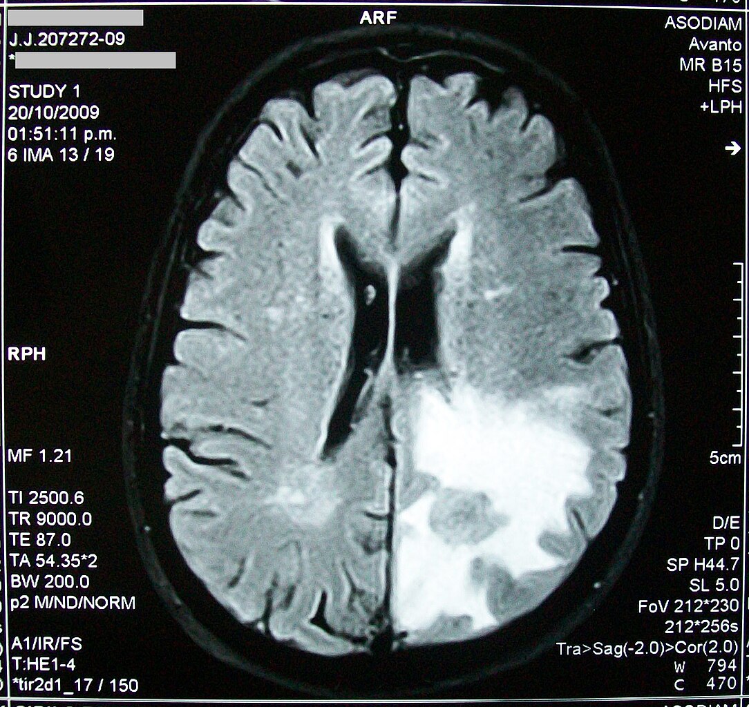 brain mri scan tumor