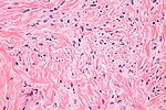 Thumbnail for Mammary-type myofibroblastoma