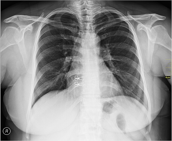 File:Medical X-Ray imaging OHJ06 nevit.jpg