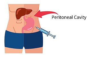 <span class="mw-page-title-main">Intraperitoneal injection</span> Injection of substances into peritoneum (body cavity)