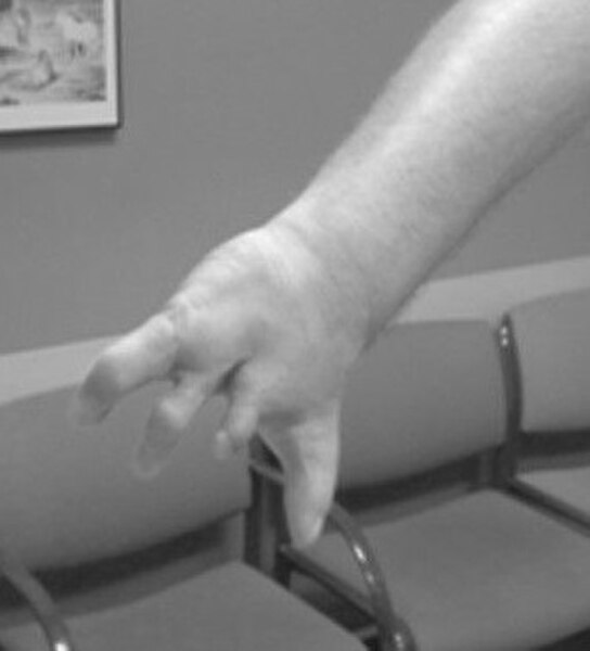 Right hand symbrachydactyly in Poland syndrome