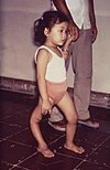 A child with a deformity of her right leg due to polio