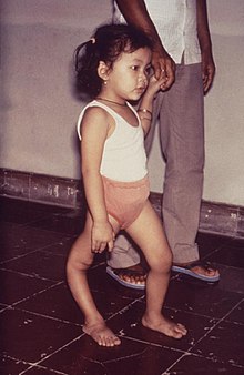 A girl with genu recurvatum of her right leg due to polio Polio sequelle.jpg