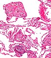 A foreign-body response to talc (talcosis) due to intravenous drug use. H&E stain.