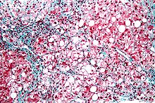 Micrograph of inflamed fatty liver (steatohepatitis) Steatohepatitis high mag.jpg