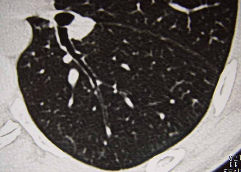 File:Systemic sclerosis case 13 pic 05 cr.jpg