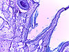 Teratoma Ovary 10x.jpg